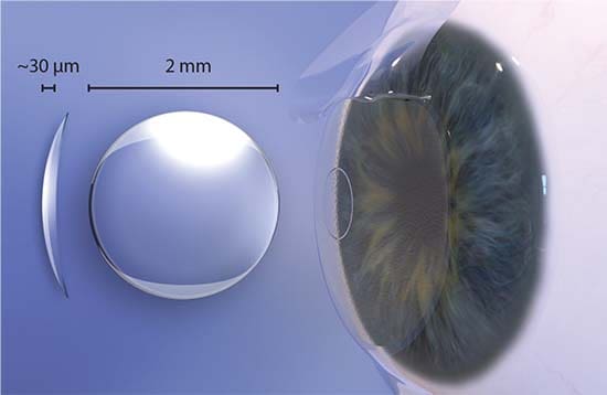 Raindrop Near Vision Inlay is unsafe per FDA