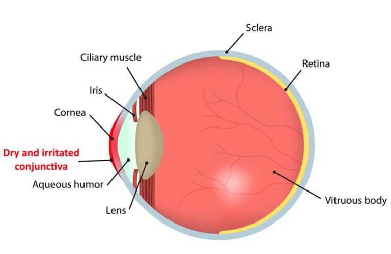 Correct Dry Eye Syndrome at LIberty Laser Eye Center