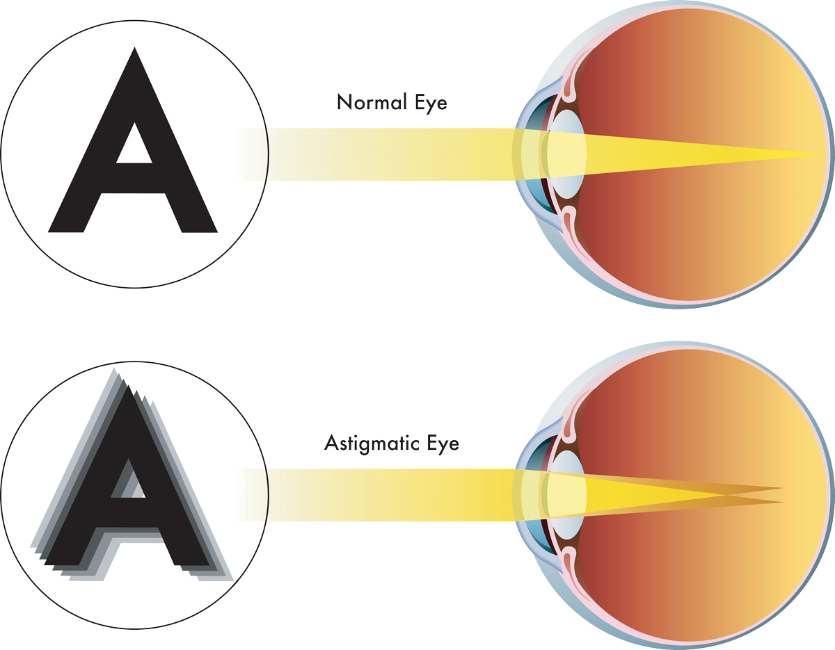 Correct Astigmatism at Liberty Laser Eye Center in the DC Metro Area