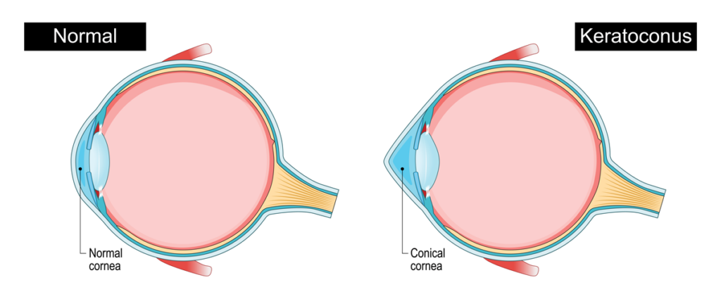 Correct Keratoconus at Liberty Laser Eye Center