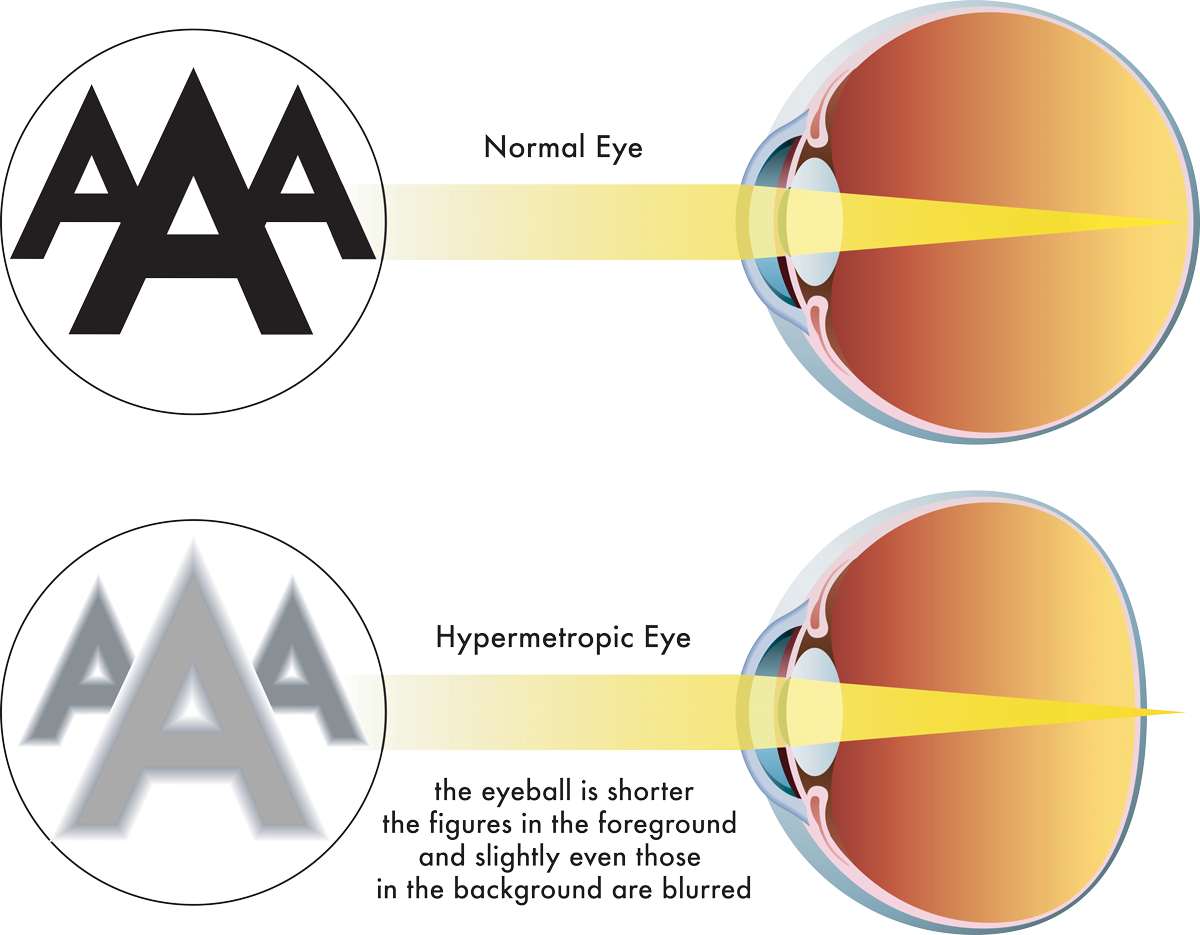 Correct Farsightedness at Liberty Laser Eye Serving the DC Metro Area