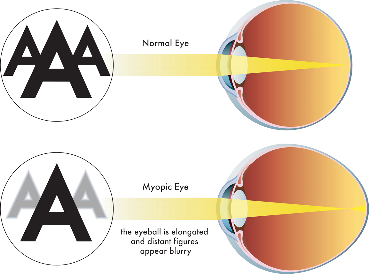 Correct Nearsightedness and Myopia at Liberty Laser Eye Center in the DC Metro Area